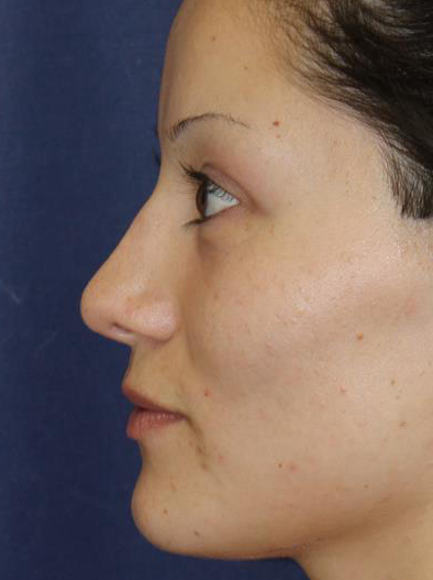 Rhinoplasty Before & After Patient #1699