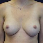 Breast Augmentation Before & After Patient #2391