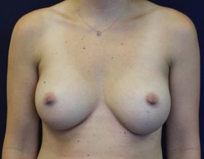 Breast Augmentation Before & After Patient #2391
