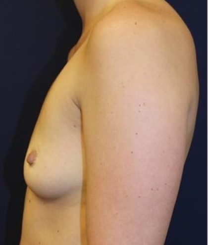 Breast Augmentation Before & After Patient #2391