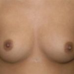 Breast Augmentation Before & After Patient #2336