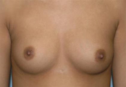 Breast Augmentation Before & After Patient #2336