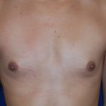 Breast Augmentation Before & After Patient #3421