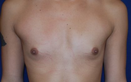 Breast Augmentation Before & After Patient #3421