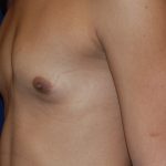 Breast Augmentation Before & After Patient #3421