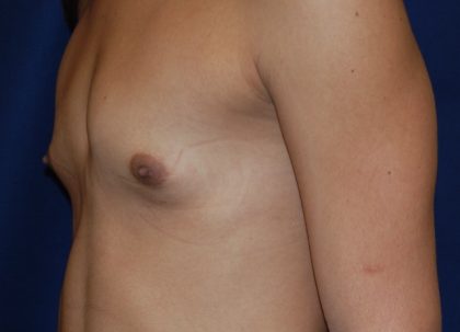 Breast Augmentation Before & After Patient #3421