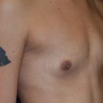 Breast Augmentation Before & After Patient #3421