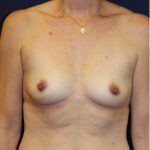 Breast Augmentation Before & After Patient #3319