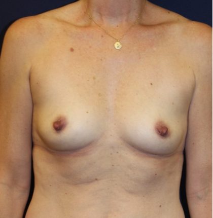 Breast Augmentation Before & After Patient #3319