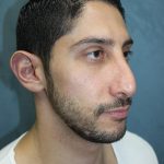 Rhinoplasty Before & After Patient #1641