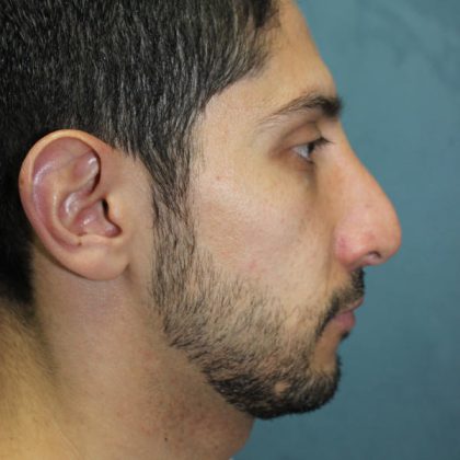 Rhinoplasty Before & After Patient #1641