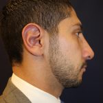 Rhinoplasty Before & After Patient #1641