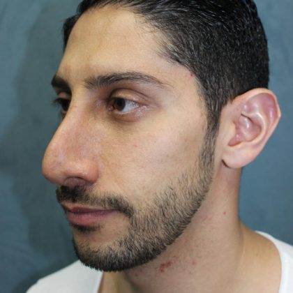 Rhinoplasty Before & After Patient #1641