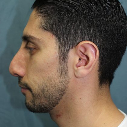 Rhinoplasty Before & After Patient #1641