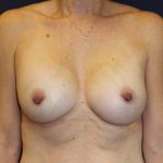 Breast Augmentation Before & After Patient #3319