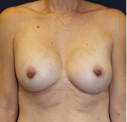 Breast Augmentation Before & After Patient #3319