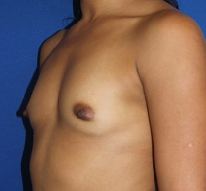 Breast Augmentation Before & After Patient #2539