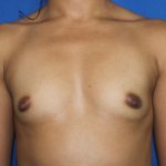 Breast Augmentation Before & After Patient #2539