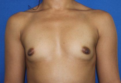 Breast Augmentation Before & After Patient #2539