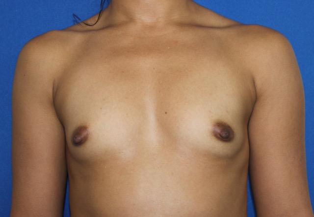 Breast Augmentation Before & After Patient #2539