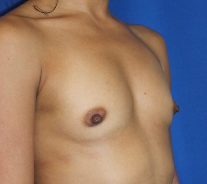 Breast Augmentation Before & After Patient #2539