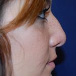 Rhinoplasty Before & After Patient #1693