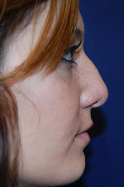 Rhinoplasty Before & After Patient #1693