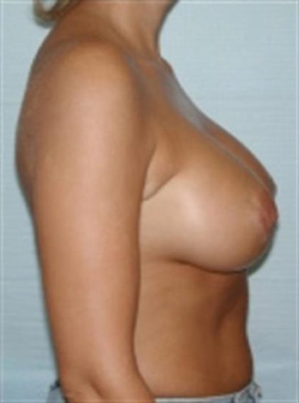 Breast Augmentation Before & After Patient #2261