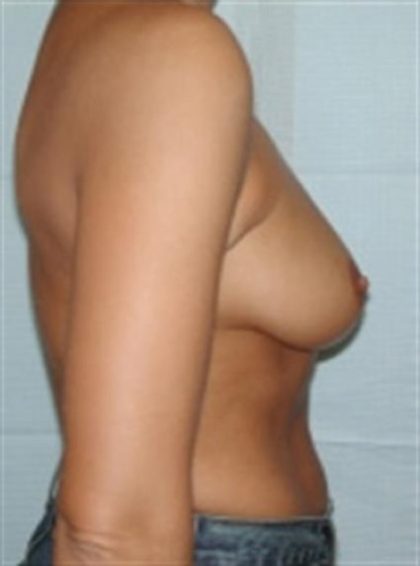 Breast Augmentation Before & After Patient #2261