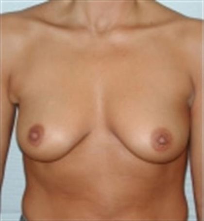 Breast Augmentation Before & After Patient #2261