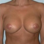 Breast Augmentation Before & After Patient #2261