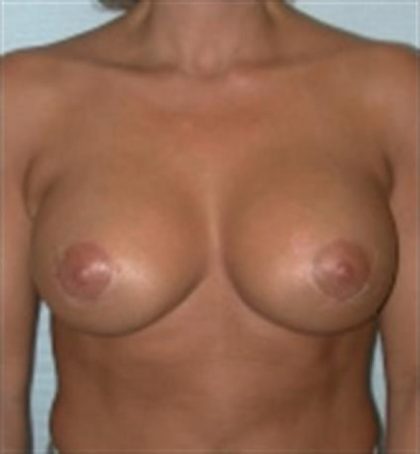 Breast Augmentation Before & After Patient #2261