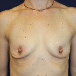 Breast Augmentation Before & After Patient #2203