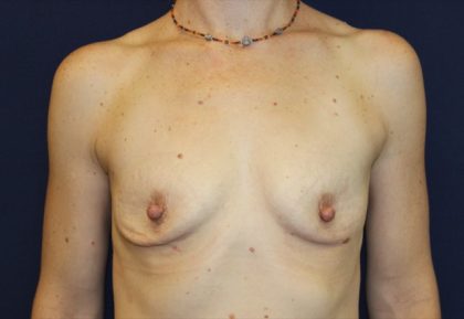 Breast Augmentation Before & After Patient #2203