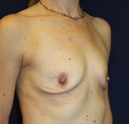 Breast Augmentation Before & After Patient #2203