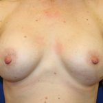 Breast Augmentation Before & After Patient #2203