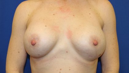 Breast Augmentation Before & After Patient #2203