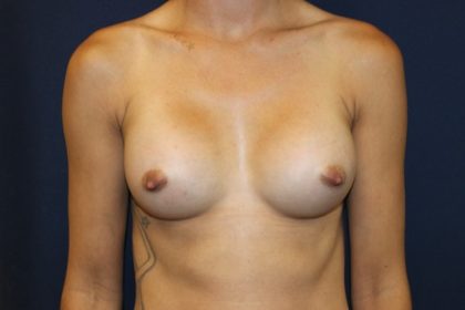 Breast Augmentation Before & After Patient #2499