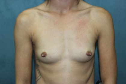Breast Augmentation Before & After Patient #2499