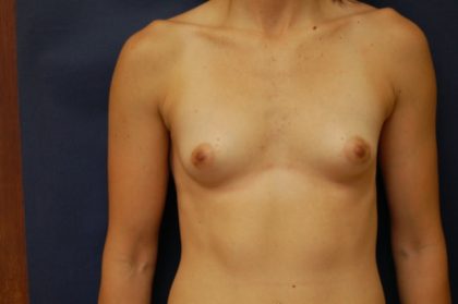 Breast Augmentation Before & After Patient #2178