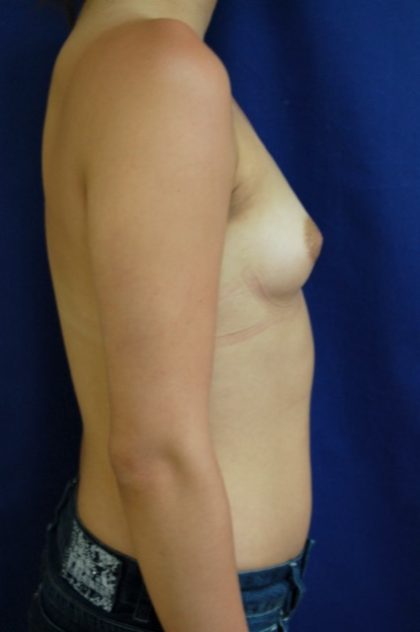 Breast Augmentation Before & After Patient #2183