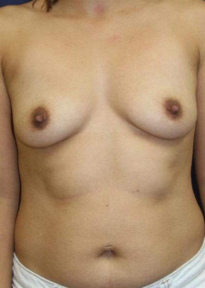 Breast Augmentation Before & After Patient #2309