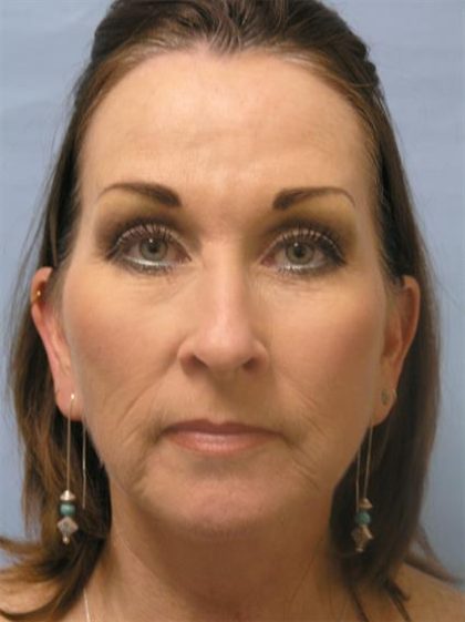 Facelift Before & After Patient #561