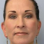 Facelift Before & After Patient #561