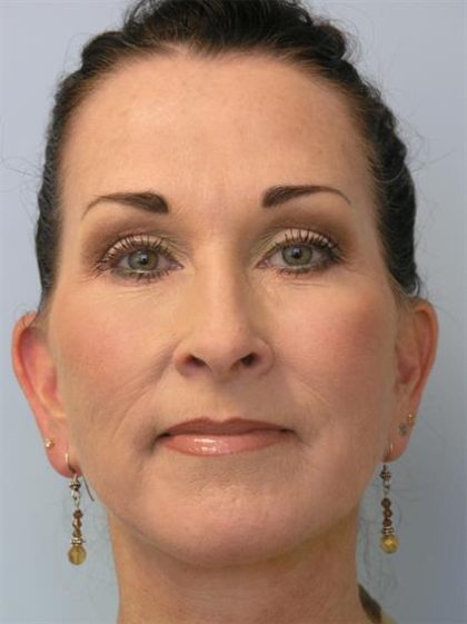 Facelift Before & After Patient #561