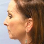 Facelift Before & After Patient #561