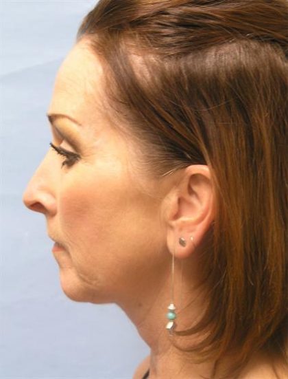 Facelift Before & After Patient #561