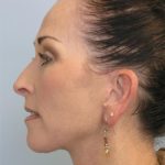 Facelift Before & After Patient #561