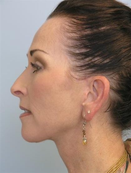 Facelift Before & After Patient #561