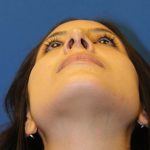 Rhinoplasty Before & After Patient #3573